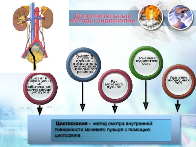 Цистоскопия - метод омотра внутренней поверхности мочевого пузыря с помощью
