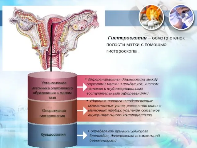 диференциальная диагностика между опухолями матки и придатков, кистом яичников и