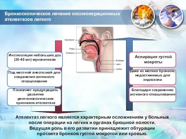 Бронхоскопическое лечение послеоперационных ателектазов легкого Ателектаз легкого является характерным осложнением