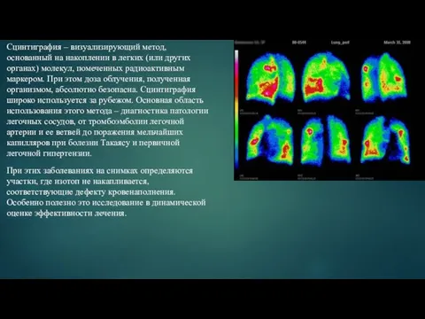 Сцинтиграфия – визуализирующий метод, основанный на накоплении в легких (или других органах) молекул,