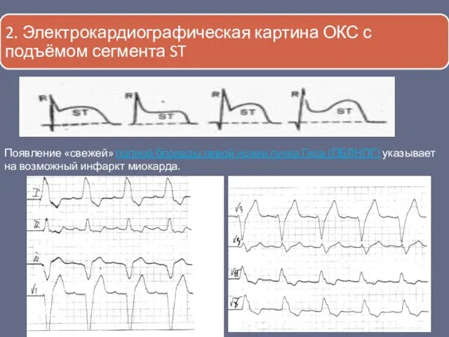 Появление «свежей» полной блокады левой ножки пучка Гиса (ПБЛНПГ) указывает на возможный инфаркт миокарда.