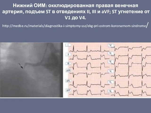 Нижний ОИМ: окклюдированная правая венечная артерия, подъем ST в отведениях