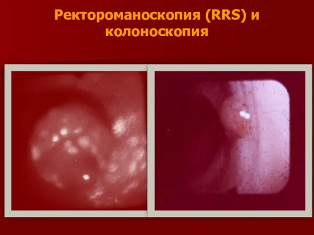 Ректороманоскопия (RRS) и колоноскопия