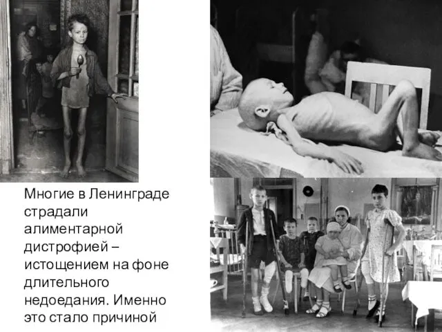 Многие в Ленинграде страдали алиментарной дистрофией – истощением на фоне