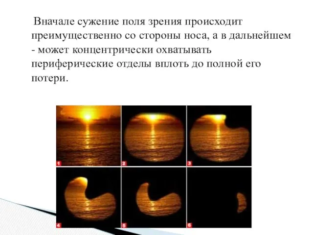 Вначале сужение поля зрения происходит преимущественно со стороны носа, а