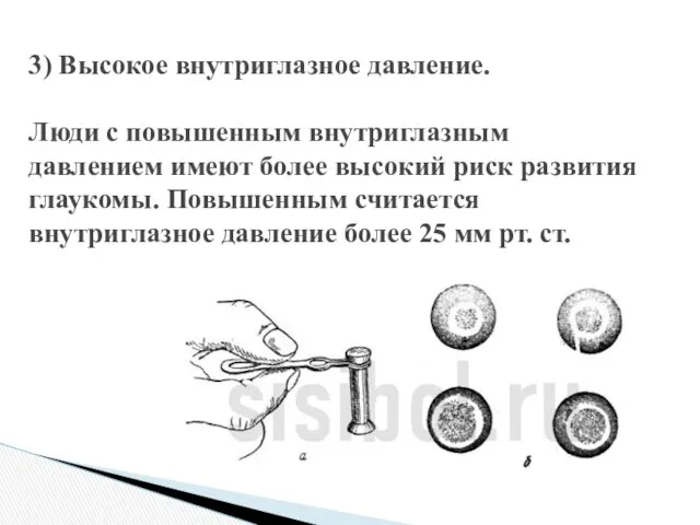 3) Высокое внутриглазное давление. Люди с повышенным внутриглазным давлением имеют