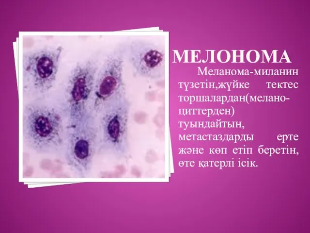 МЕЛОНОМА Меланома-миланин түзетін,жүйке тектес торшалардан(мелано- циттерден)туындайтын,метастаздарды ерте және көп етіп беретін,өте қатерлі ісік.