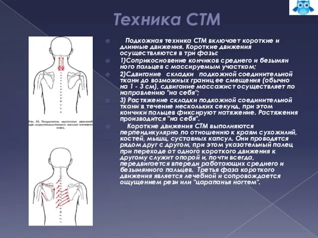 Техника СТМ Подкожная техника СТМ включает короткие и длинные движения.