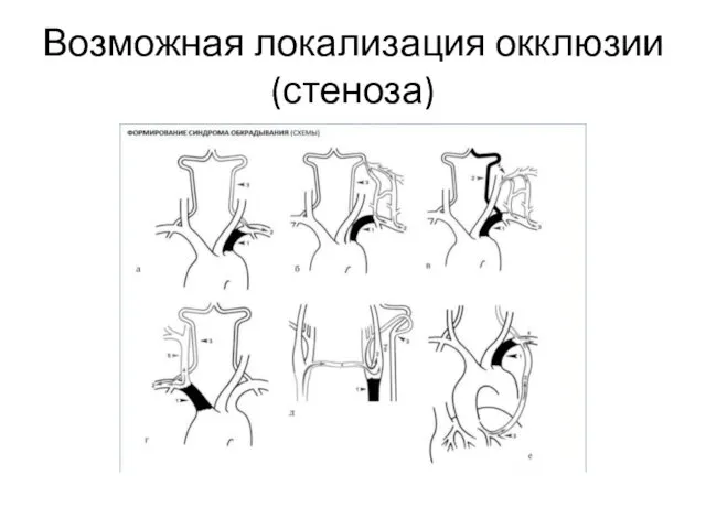 Возможная локализация окклюзии (стеноза)