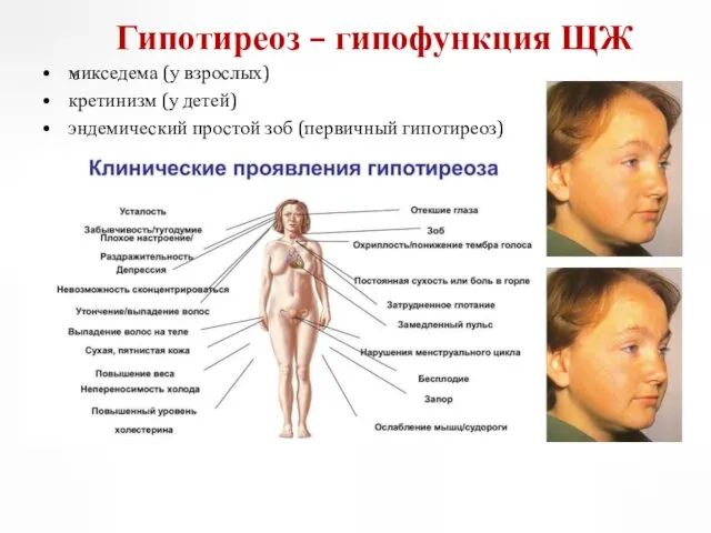 микседема (у взрослых) кретинизм (у детей) эндемический простой зоб (первичный гипотиреоз) Гипотиреоз – гипофункция ЩЖ