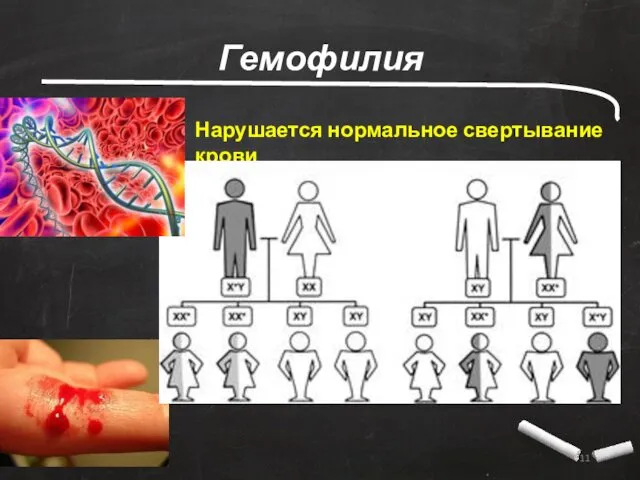 Гемофилия Нарушается нормальное свертывание крови