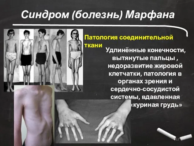 Синдром (болезнь) Марфана Патология соединительной ткани Удлинённые конечности, вытянутые пальцы , недоразвитие жировой