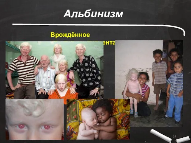 Альбинизм Врождённое отсутствие пигмента меланина