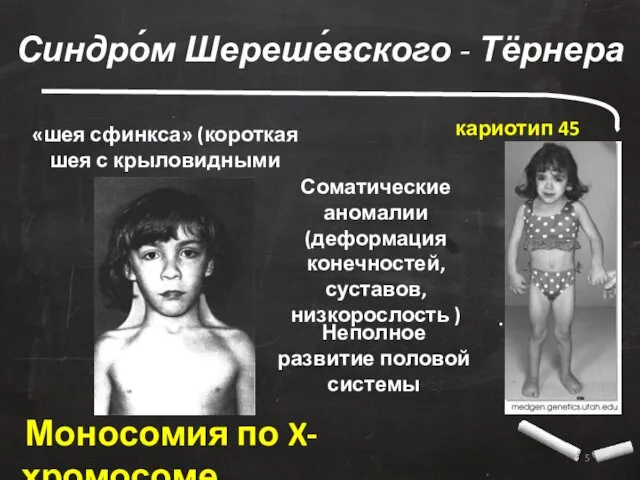. Синдро́м Шереше́вского - Тёрнера Моносомия по X-хромосоме «шея сфинкса» (короткая шея с