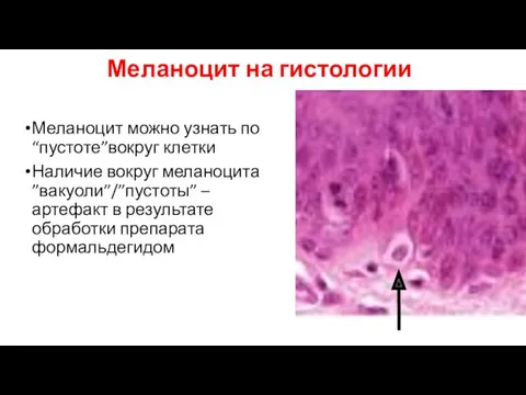 Меланоцит на гистологии Меланоцит можно узнать по “пустоте”вокруг клетки Наличие вокруг меланоцита ”вакуоли”/”пустоты”