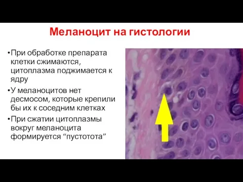 При обработке препарата клетки сжимаются, цитоплазма поджимается к ядру У меланоцитов нет десмосом,
