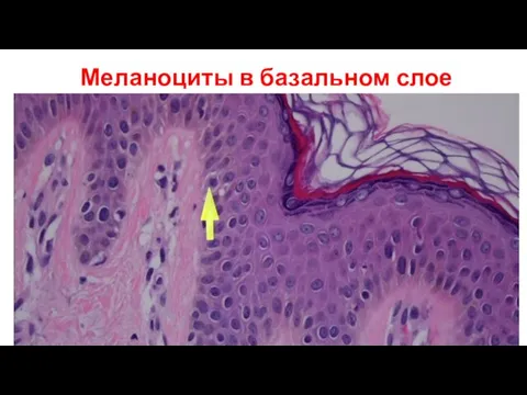 Меланоциты в базальном слое