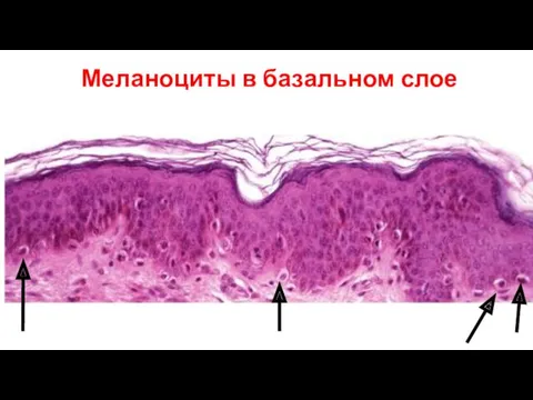 Меланоциты в базальном слое