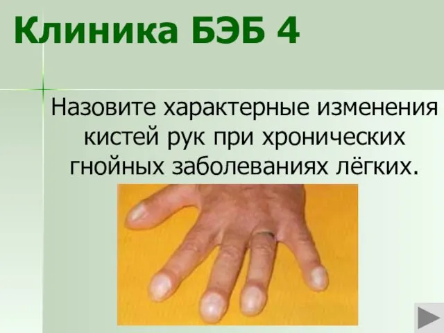 Клиника БЭБ 4 Назовите характерные изменения кистей рук при хронических гнойных заболеваниях лёгких.