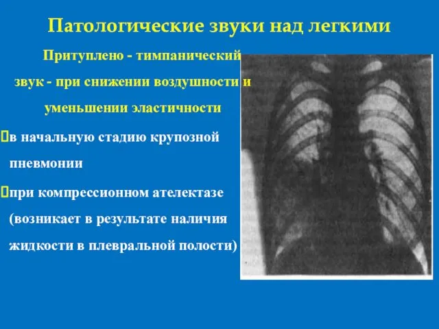 Патологические звуки над легкими Притуплено - тимпанический звук - при