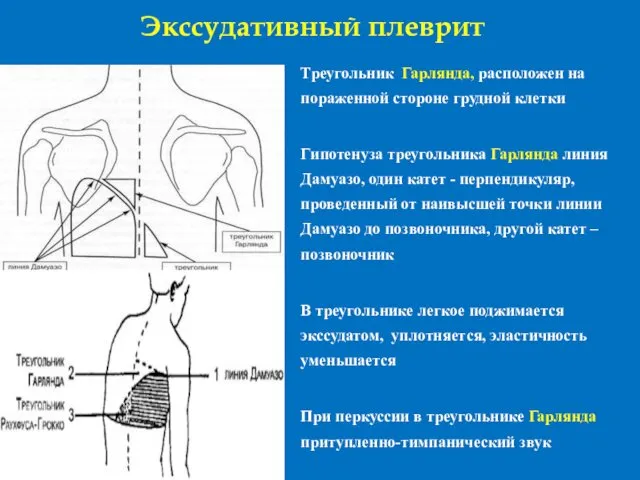 Экссудативный плеврит Треугольник Гарлянда, расположен на пораженной стороне грудной клетки