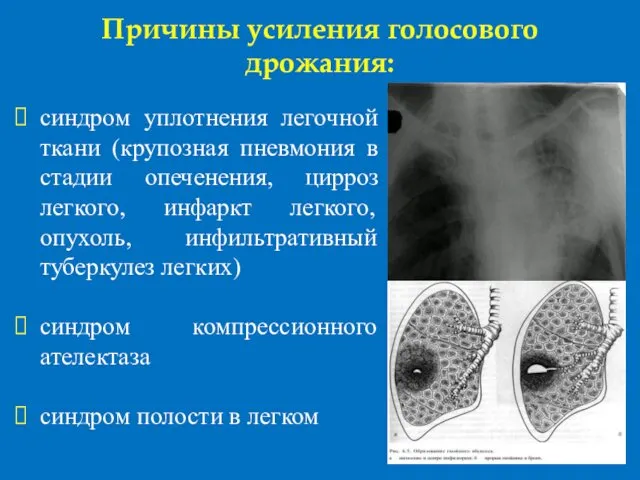 Причины усиления голосового дрожания: синдром уплотнения легочной ткани (крупозная пневмония