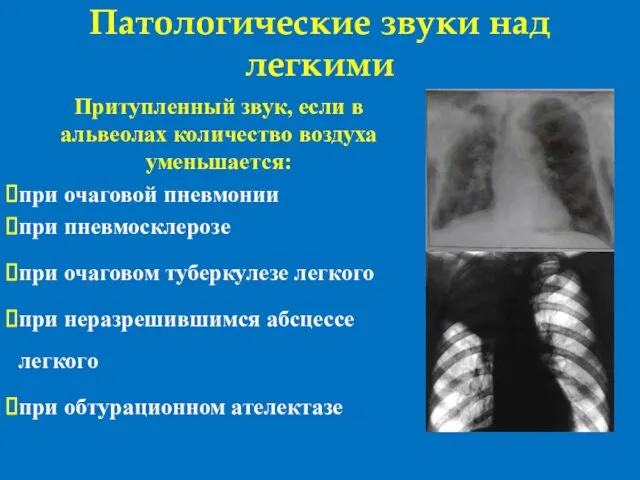 Патологические звуки над легкими Притупленный звук, если в альвеолах количество