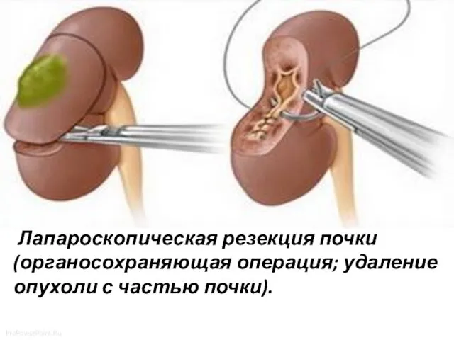 Лапароскопическая резекция почки (органосохраняющая операция; удаление опухоли с частью почки).