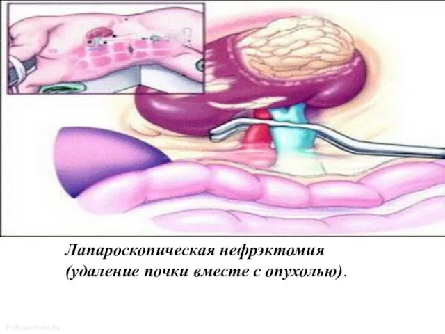 Лапароскопическая нефрэктомия (удаление почки вместе с опухолью).
