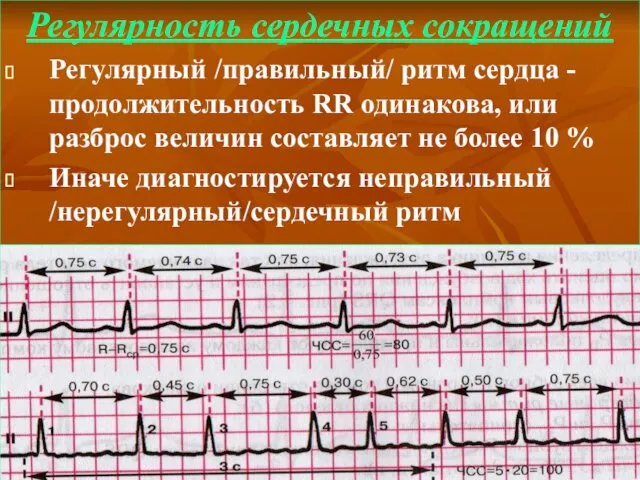 Регулярность сердечных сокращений Регулярный /правильный/ ритм сердца -продолжительность RR одинакова,
