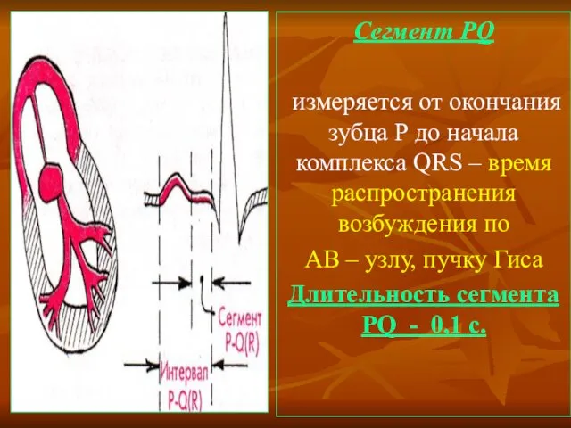 Сегмент PQ измеряется от окончания зубца Р до начала комплекса