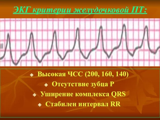 ЭКГ критерии желудочковой ПТ: Высокая ЧСС (200, 160, 140) Отсутствие