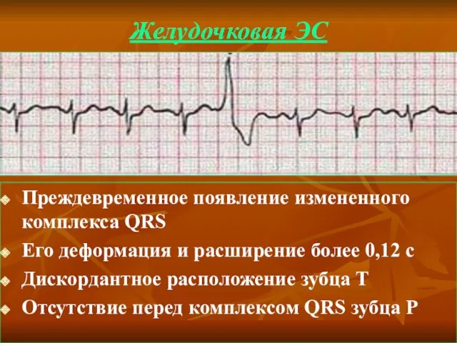 Желудочковая ЭС Преждевременное появление измененного комплекса QRS Его деформация и