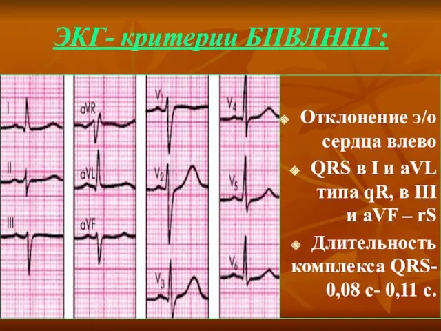 ЭКГ- критерии БПВЛНПГ: Отклонение э/о сердца влево QRS в I
