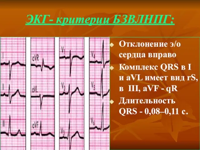 ЭКГ- критерии БЗВЛНПГ: Отклонение э/о сердца вправо Комплекс QRS в