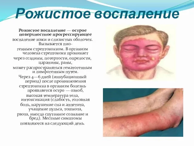 Рожистое воспаление Рожистое воспаление — острое поверхностное прогрессирующее воспаление кожи и слизистых оболочек.