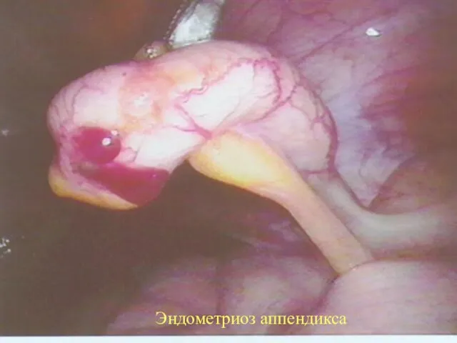 Эндометриоз аппендикса