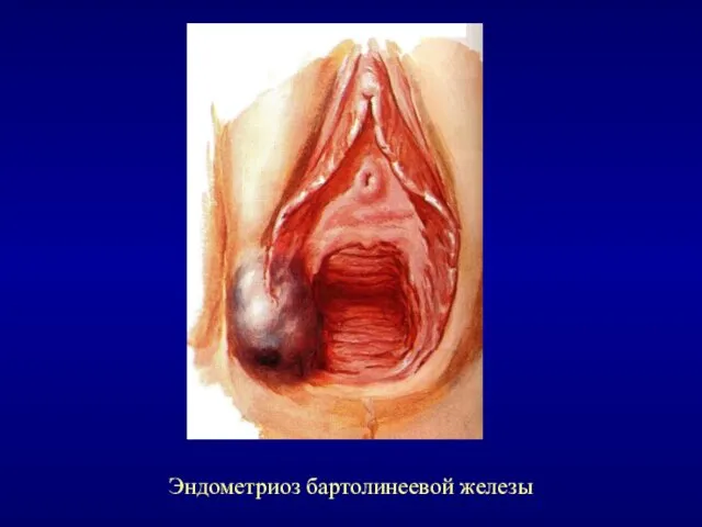 Эндометриоз бартолинеевой железы