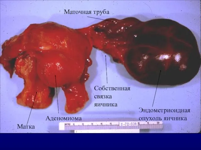 Матка Эндометриоидная опухоль яичника Собственная связка яичника Маточная труба Аденомиома
