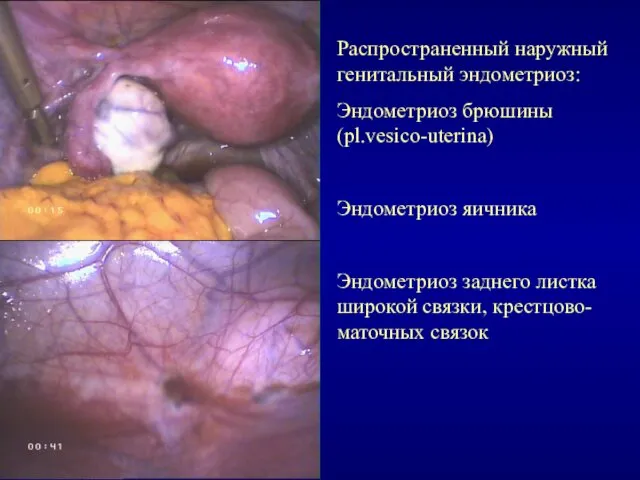 Распространенный наружный генитальный эндометриоз: Эндометриоз брюшины (pl.vesico-uterina) Эндометриоз яичника Эндометриоз заднего листка широкой связки, крестцово-маточных связок