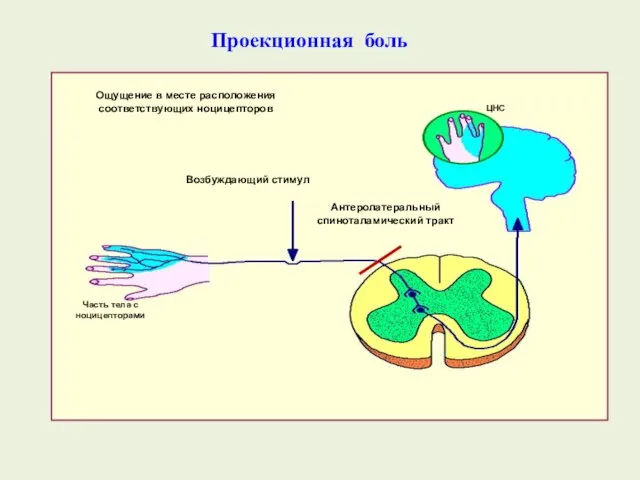 Проекционная боль