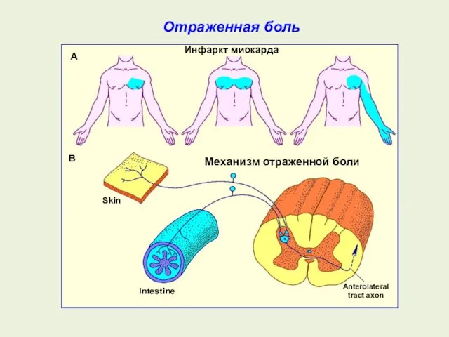 Отраженная боль Инфаркт миокарда Механизм отраженной боли