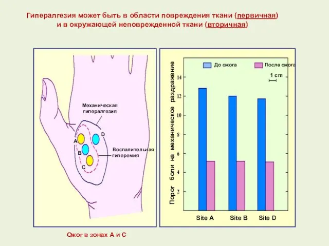 Гипералгезия может быть в области повреждения ткани (первичная) и в окружающей неповрежденной ткани