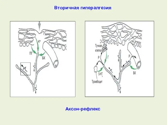 Аксон-рефлекс Вторичная гипералгезия