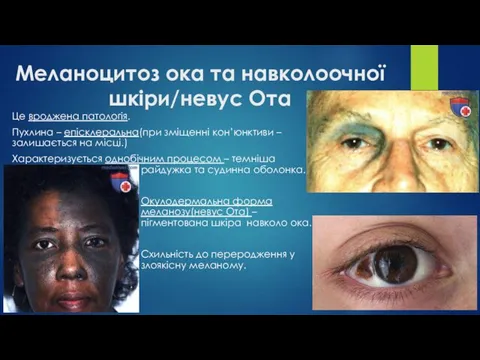 Меланоцитоз ока та навколоочної шкіри/невус Ота Це вроджена патологія. Пухлина – епісклеральна(при зміщенні
