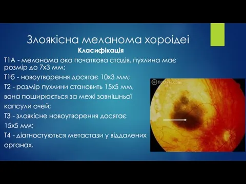 Злоякісна меланома хороідеі Класифікація Т1А - меланома ока початкова стадія, пухлина має розмір