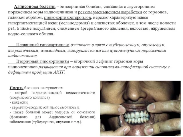 Аддисонова болезнь – эндокринная болезнь, связанная с двусторонним поражением коры