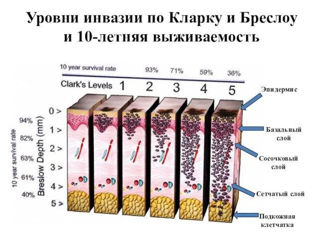 Уровни инвазии по Кларку и Бреслоу и 10-летняя выживаемость