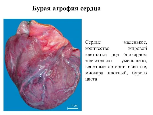 Сердце маленькое, количество жировой клетчатки под эпикардом значительно уменьшено, венечные