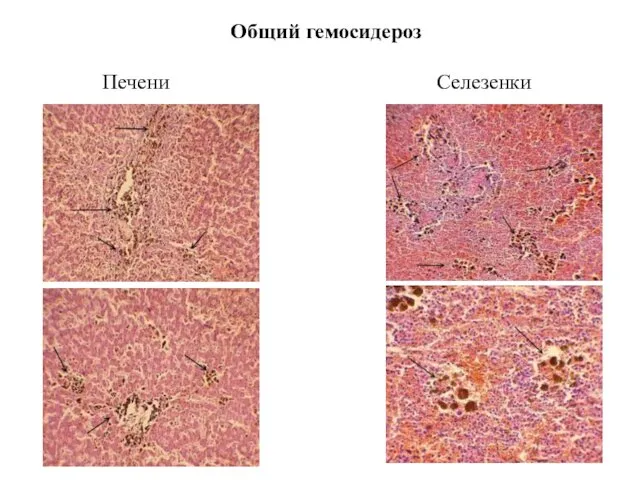 Общий гемосидероз Печени Селезенки